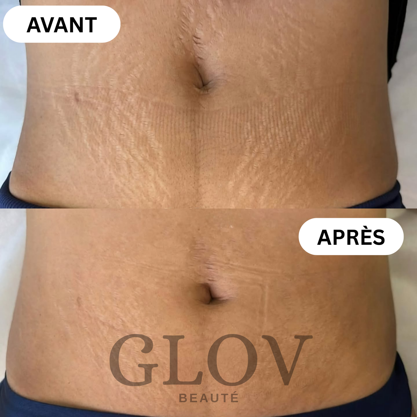 Kit Glov Beauté Vergeture
