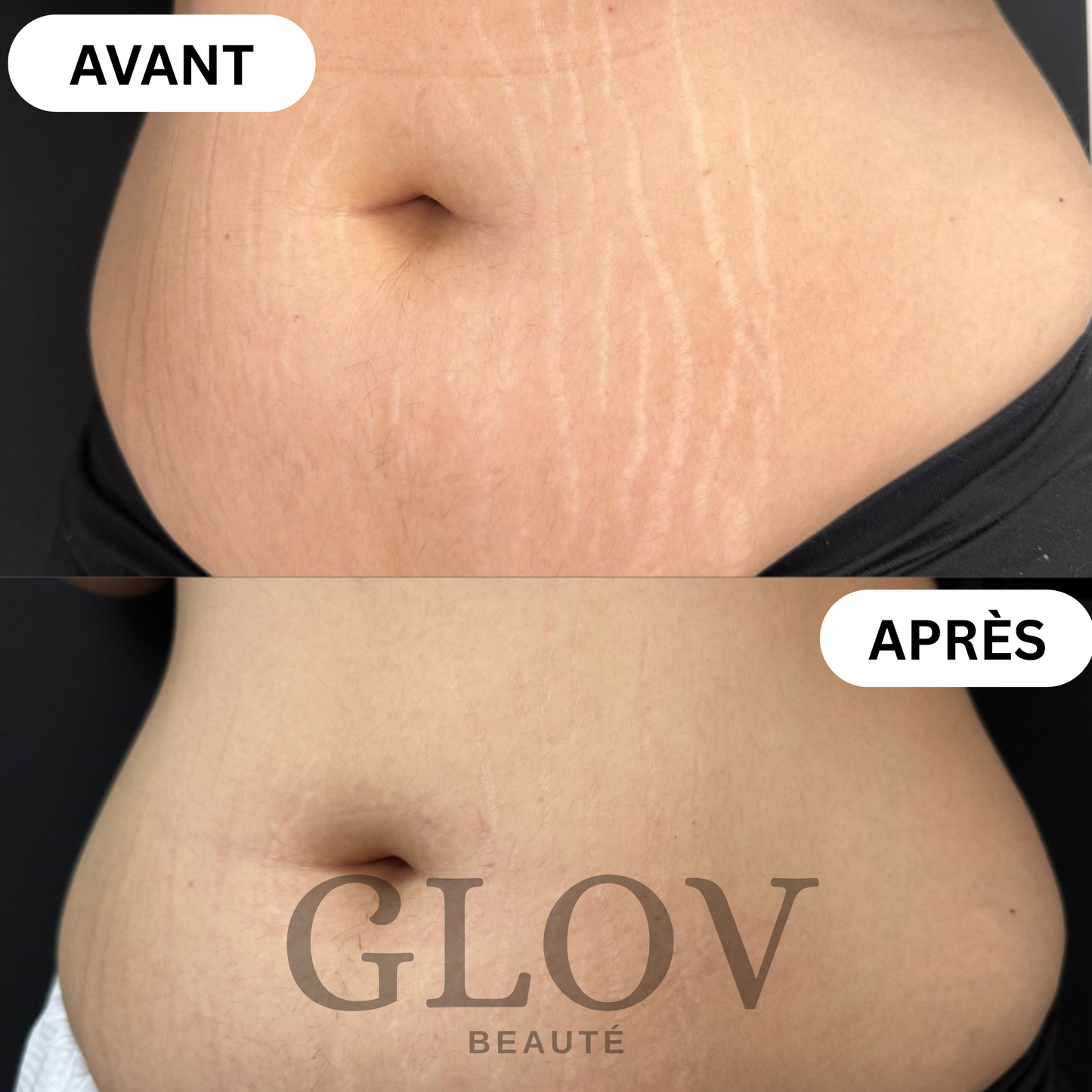 Kit Glov Beauté Vergeture