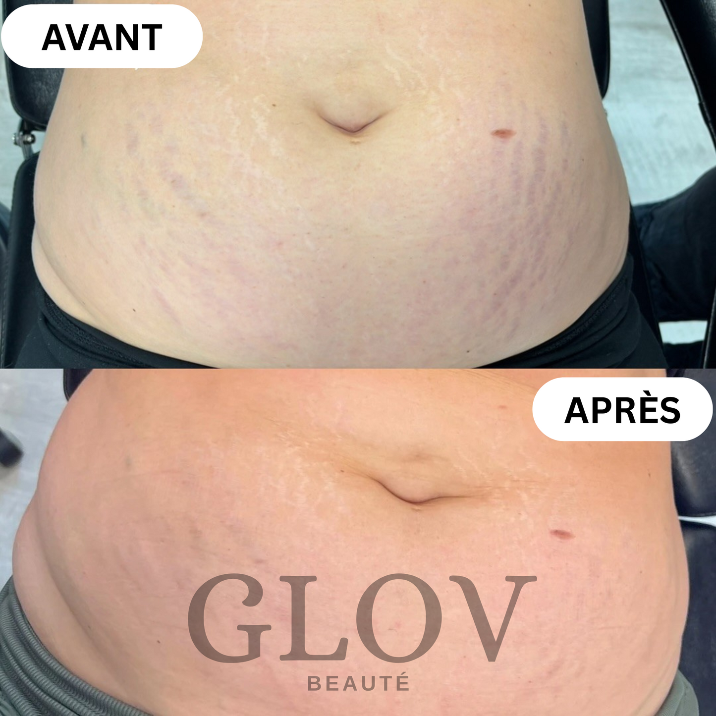 Kit Glov Beauté Vergeture