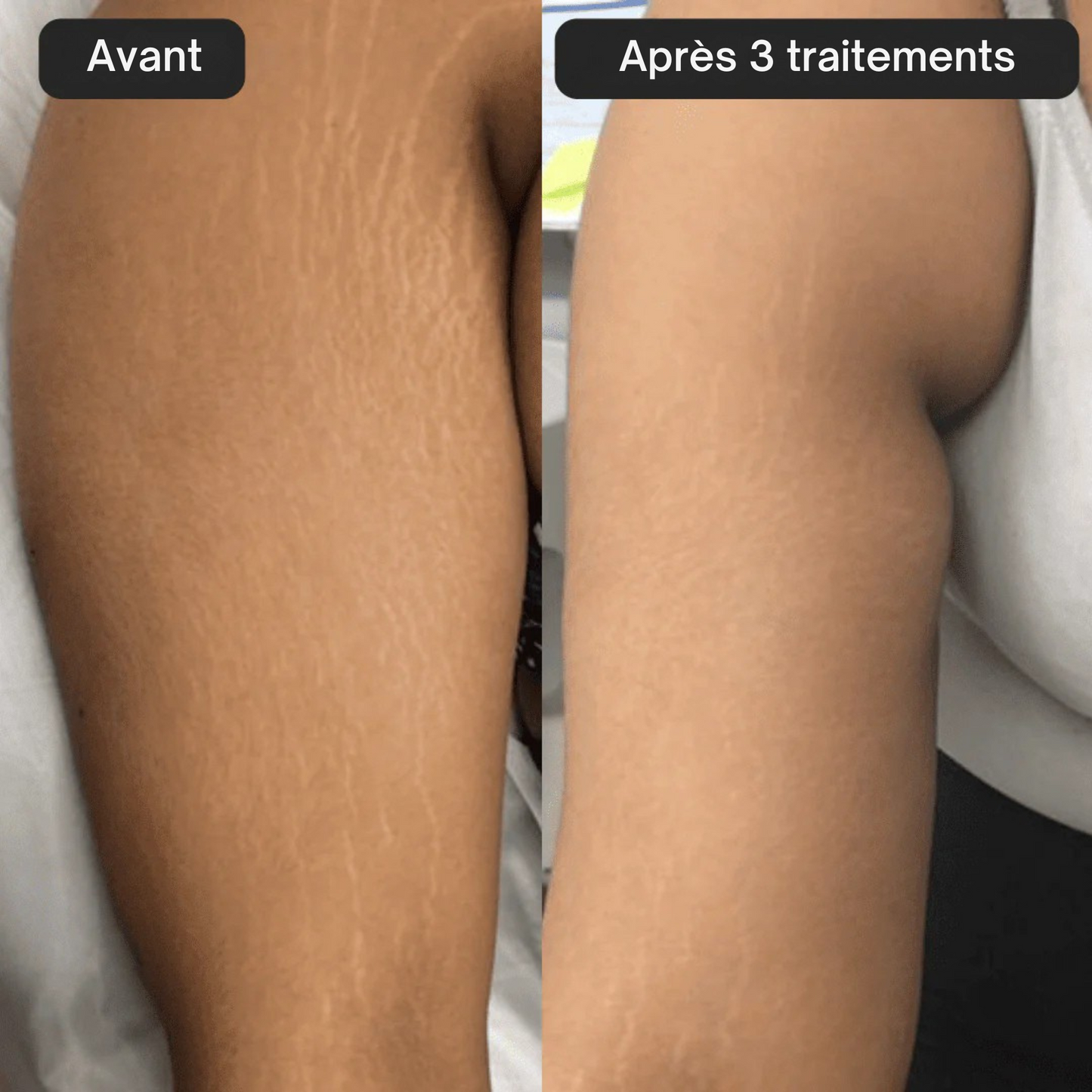Kit Glov Beauté Vergeture