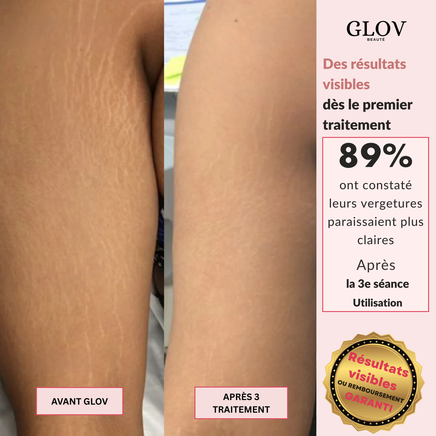 Kit Glov Beauté Vergeture