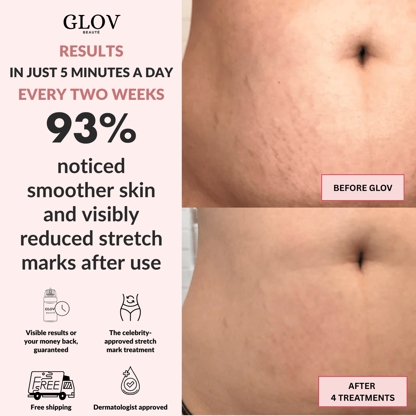 Glov Beauty Stretch Mark Kit