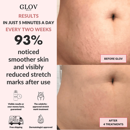 Glov Beauty Stretch Mark Kit