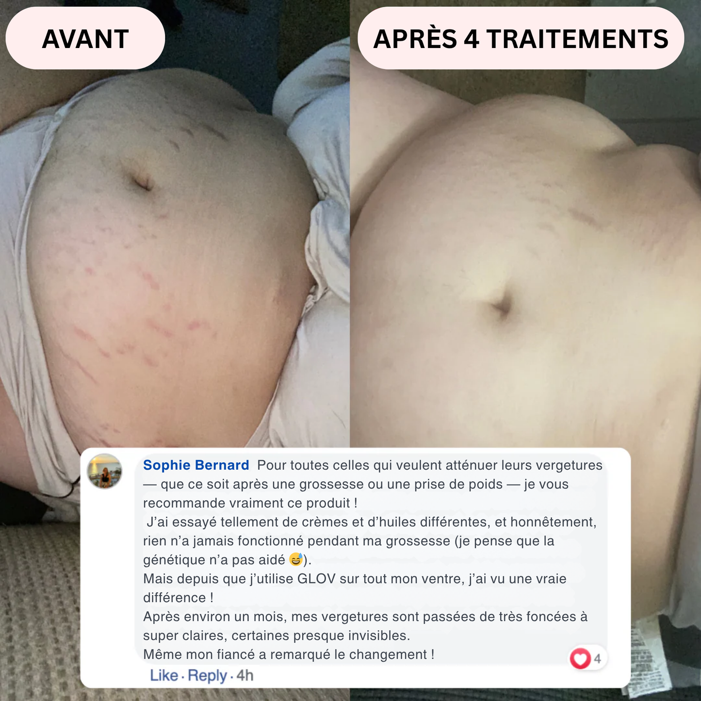 Glov Beauty Stretch Mark Kit