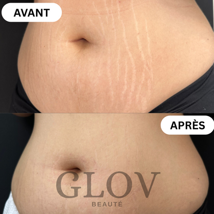 Kit Glov Beauté Vergeture