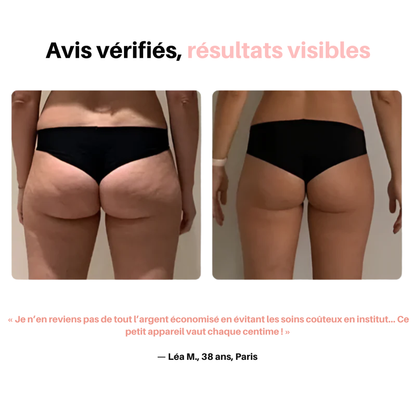 GlovFit | Masseur Anti cellulite