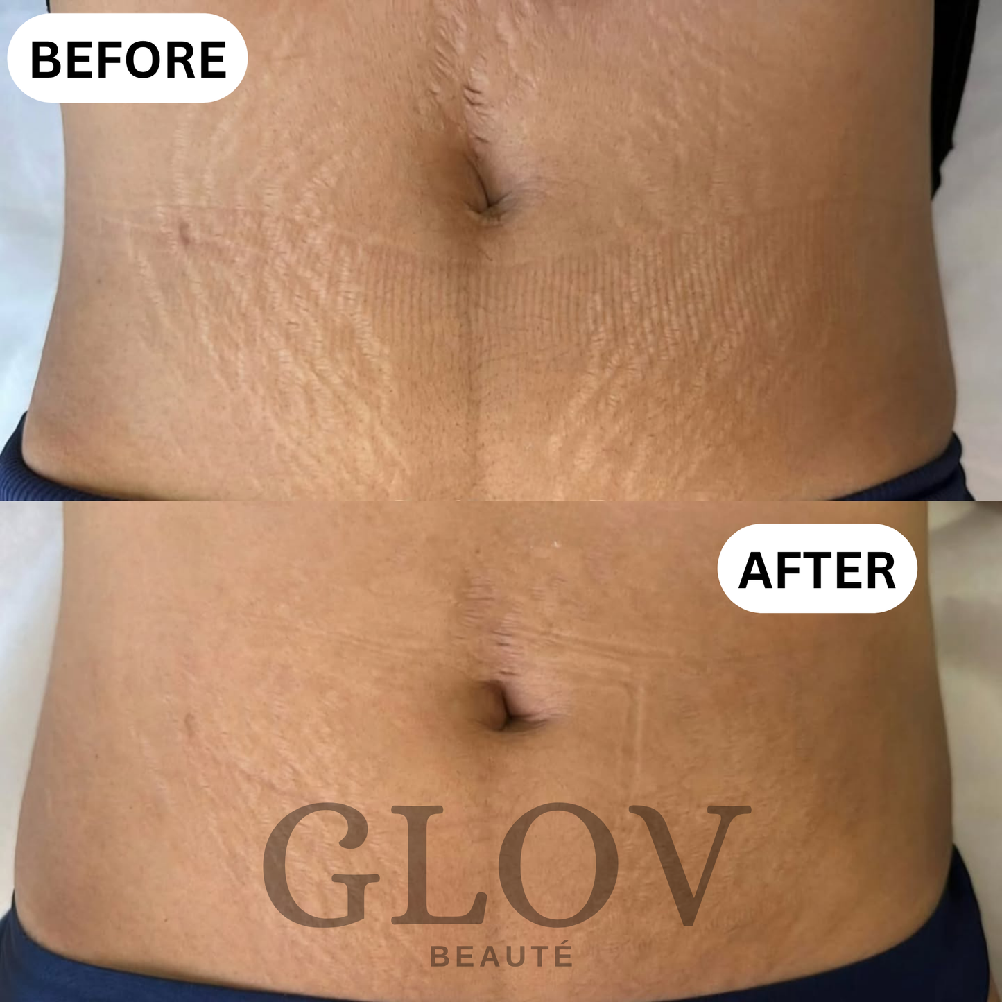 Glov Beauty Stretch Mark Kit