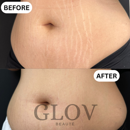 Glov Beauty Stretch Mark Kit