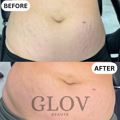 Glov Beauty Stretch Mark Kit