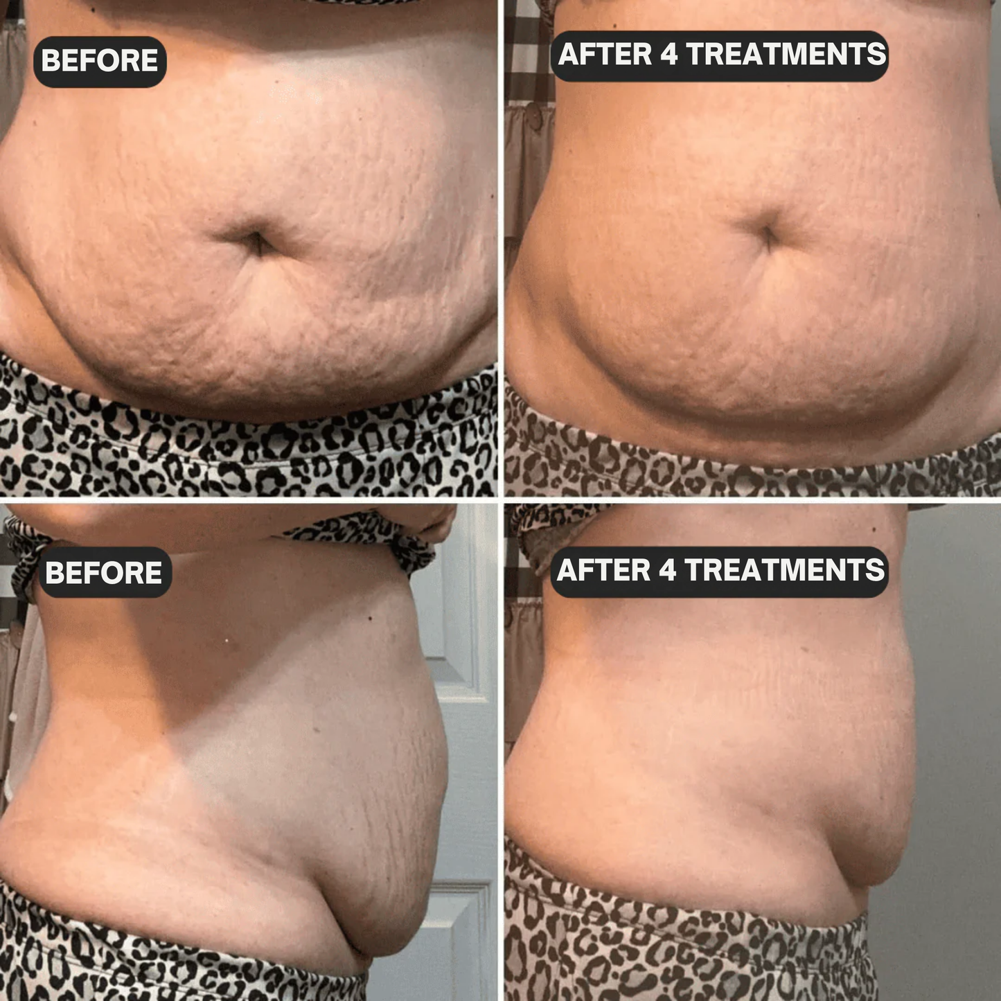 Glov Beauty Stretch Mark Kit