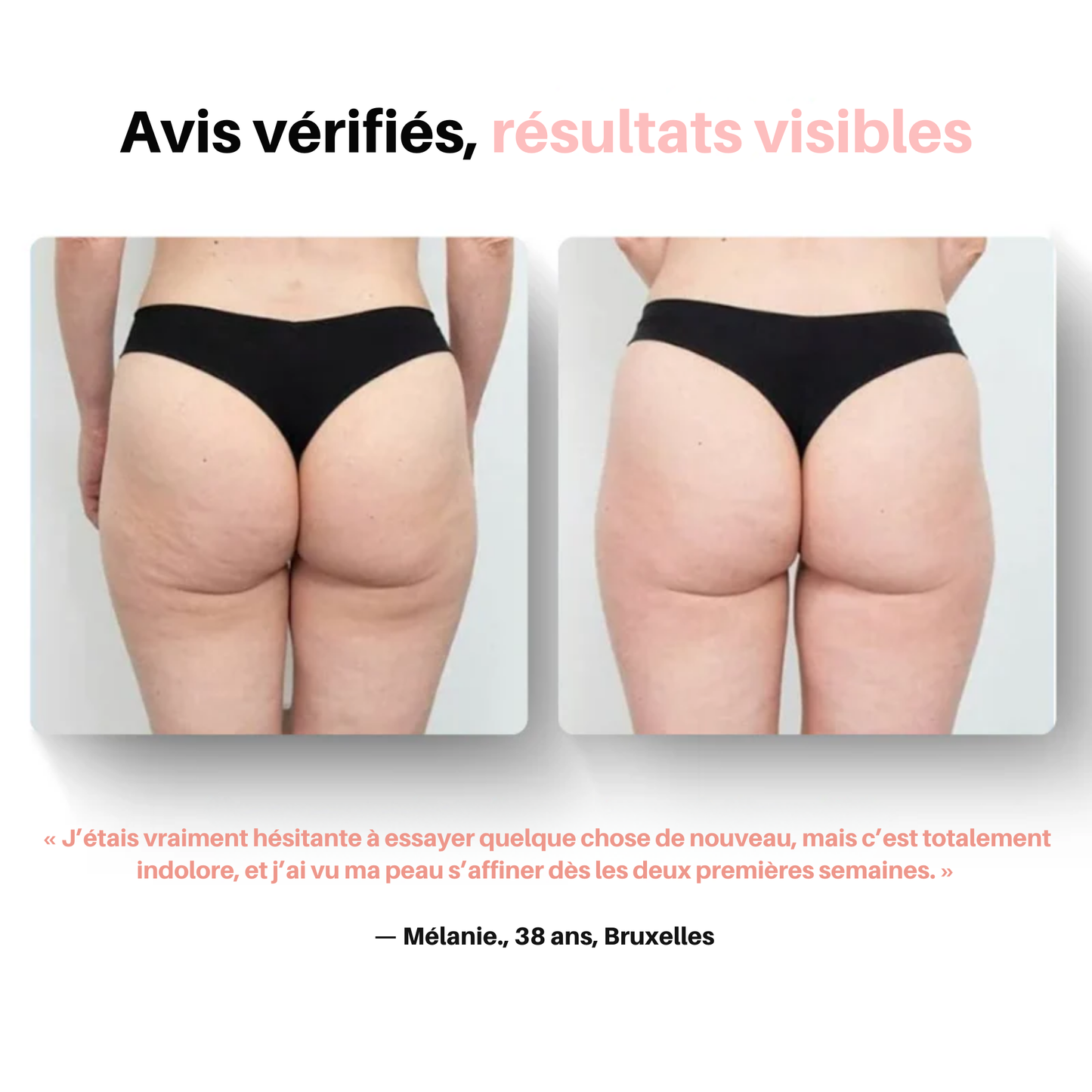 GlovFit | Masseur Anti cellulite