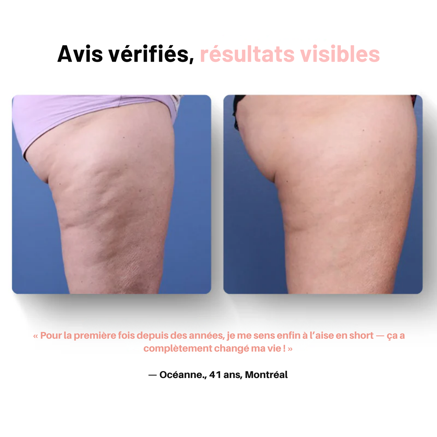 GlovFit | Masseur Anti cellulite