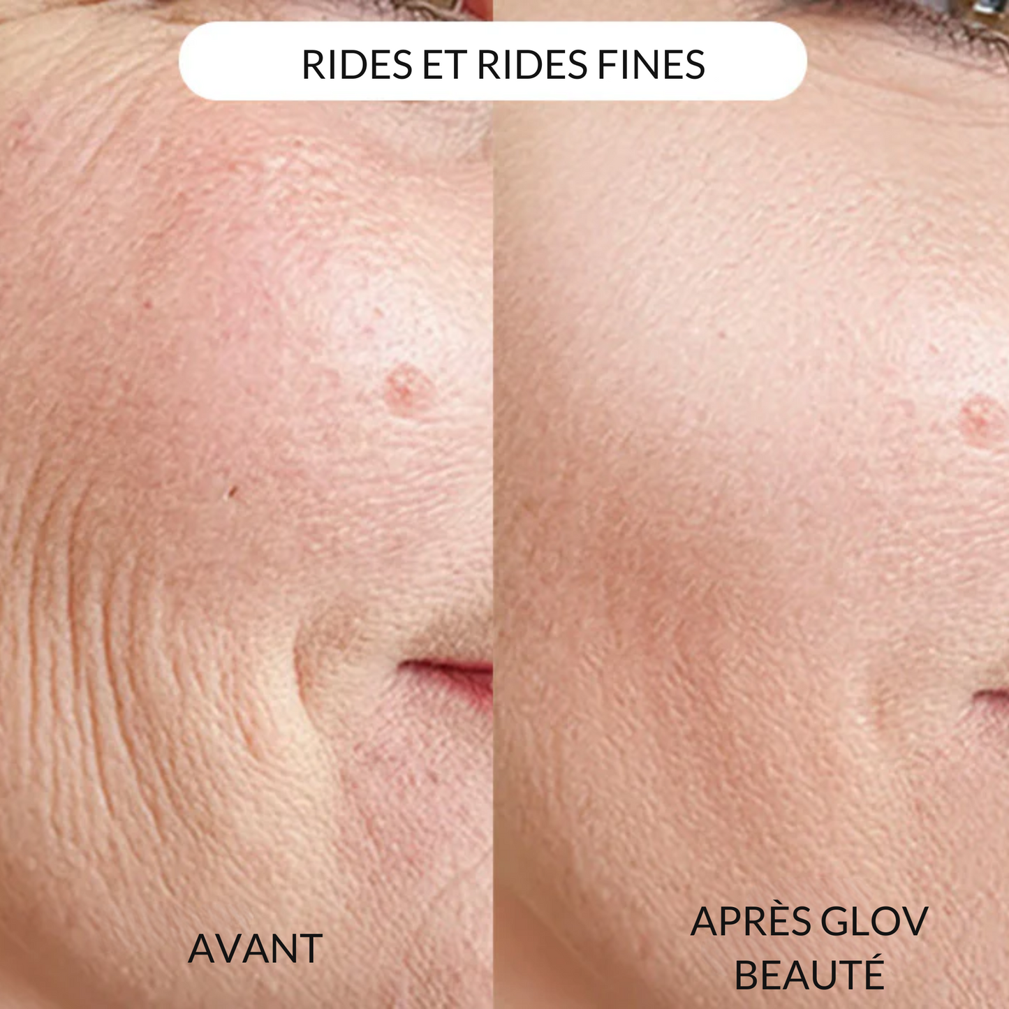 Système de micro perfusion Glov Beauté