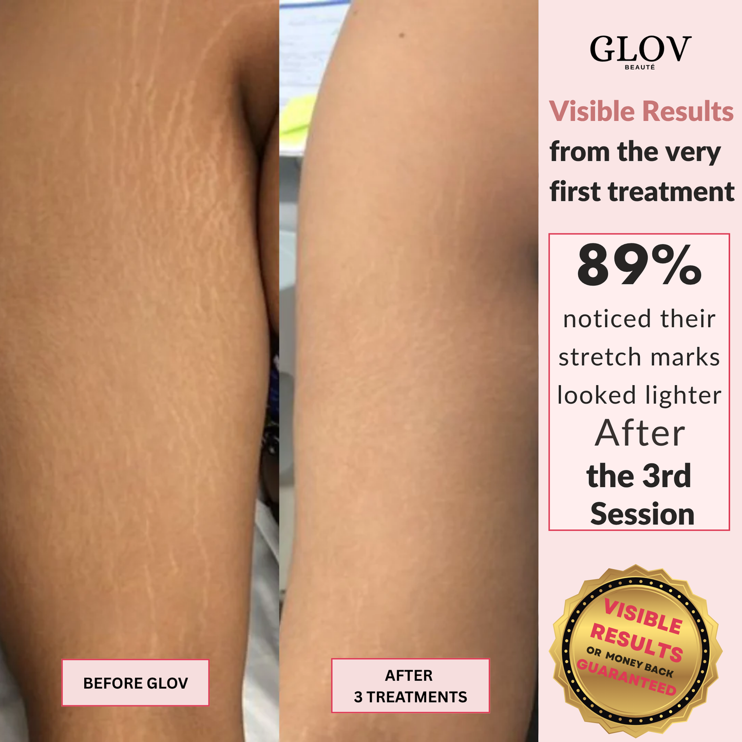 Glov Beauty Stretch Mark Kit